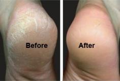Soften and Get Rid of Tough Calluses: blend two tablespoons of baking soda in a basin of warm water and add a few drops of lavender oil. After a nice long soak, scrub them away using three parts baking soda, one part water, and one part brown sugar. Follow with an application of a rich moisturizer and a warm towel foot wrap. Let sit for 5-10 minutes....