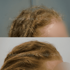 Personalised Hair Loss Solutions in Sydney

Restore your confidence with natural hair loss treatment in Sydney provided by Australian Hair & Scalp Clinics. Using our innovative Herbal Follicular Activation (HFA) method, we address the root causes of hair loss through customised, drug-free solutions. Experience hair regrowth that is safe, sustainable, and tailored to your needs. 

 

Expert trichologists offering professional scalp evaluations. 

Herbal treatments are designed to suit individual conditions. 

Visible results within months without side effects. 

 

Start your transformation today! Contact us at 1800 001 101 to book a consultation for hair loss treatment in Sydney. 