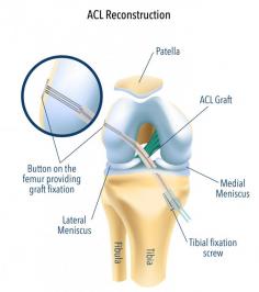 Trusted Care for Your ACL Reconstruction Surgery

Recovering from an ACL injury requires precise care. ACL reconstruction surgery is pivotal in restoring knee stability and preventing long-term complications. Trust Mr Vishal Pai for tailored, expert care. Here’s why you should choose us:



Extensive experience in ACL reconstruction surgery for children and adults 
Advanced techniques to ensure optimum knee stability 
Comprehensive care, from consultation to post-operative recovery 
Detailed focus on minimising risks of re-injur 


Take a step forward and regain confidence in your mobility today.