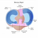 Ease Knee Pain with Reliable Meniscal Repair
Knee pain during movement can be a sign of cartilage damage. Twisting, bending, or even walking may feel uncomfortable. Meniscal repair helps restore the damaged cartilage and improve joint function.
Focused Care for Better Joint Health
Repairing the meniscus supports smoother movement.
* Preserves natural knee structure
* Helps reduce pain during activity
* Supports better joint stability
* Encourages quicker recovery
Stay Active Without Continuous Pain
With timely care, knee function can improve and daily activities become easier again. Addressing cartilage damage early helps protect long term joint health.
Do not ignore the signs your knee is giving you. Act early by scheduling your appointment with Mr Vishal Pai Orthopaedic Knee Surgeon and know about meniscal repair.