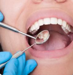 Dr Tran’s Dental Practice in Kingswood offers high-quality dental veneers for Penrith patients seeking precision and lasting results. Veneers are ultra-thin, custom-designed shells placed over teeth to improve color, shape, and alignment. They’re ideal for fixing chips, discoloration, gaps, or mild crowding. Made from either porcelain or composite resin, veneers are matched in shape and shade to suit your natural smile. Dr Tran carefully evaluates every case, ensuring each veneer supports function and aesthetics without over-preparing healthy teeth. Porcelain veneers are popular for their strength and stain resistance, while composite options offer fast, affordable results in fewer visits.
