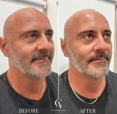 Unlike traditional facials, HydraFacial uses patented vortex technology to provide consistent, measurable results. The process standardises exfoliation and serum delivery, ensuring each layer of the skin receives the care it needs. It’s gentle enough for frequent treatments, yet effective enough to complement medical-grade procedures. Think of it as the bridge between clinical skincare and advanced dermal therapy. HydraFacial technology continues to evolve with advanced boosters and integrated LED protocols for enhanced outcomes.