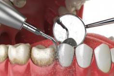 Professional cleaning removes tartar that home care can’t reach and helps detect early signs of dental issues before they become serious. Whether you’re due for your six-month check-up or returning after a long break, our clinic makes teeth cleaning simple, effective, and stress-free. With modern equipment and a calm, friendly environment, we ensure your visit is comfortable from start to finish. Book your appointment today to protect your teeth and enjoy long-term oral health.