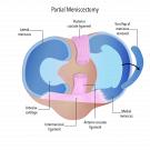 Understanding Partial Meniscectomy for Meniscus Tears
Not every meniscus tear can be repaired, and in some cases, a partial meniscectomy, removing the damaged portion of the meniscus rather than the whole structure, is the more appropriate option.
* Assessment of the tear pattern and location
* Removal limited to the damaged tissue only
* Preservation of as much healthy meniscus as possible
* Recovery expectations discussed before the procedure
Whether a partial meniscectomy or a repair is more suitable depends on where the tear sits and how the tissue responds to assessment. If partial meniscectomy has been raised as an option, discuss it with Mr Vishal Pai, orthopaedic knee surgeon in Melbourne, to understand what it involves for your specific tear.