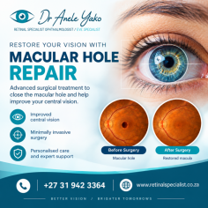 Macular Hole Repair is a specialized surgical procedure designed to treat a macular hole, a condition that affects the central part of the retina and can cause blurred or distorted vision. Using advanced microsurgical techniques, experienced retinal specialists carefully repair the macular hole to improve retinal function and support better visual outcomes. Every treatment plan is tailored to the patient's condition following a comprehensive eye examination and detailed retinal assessment. Choose a trusted ophthalmologist for macular hole repair to receive expert care, advanced surgical treatment, and personalized support throughout your vision recovery.